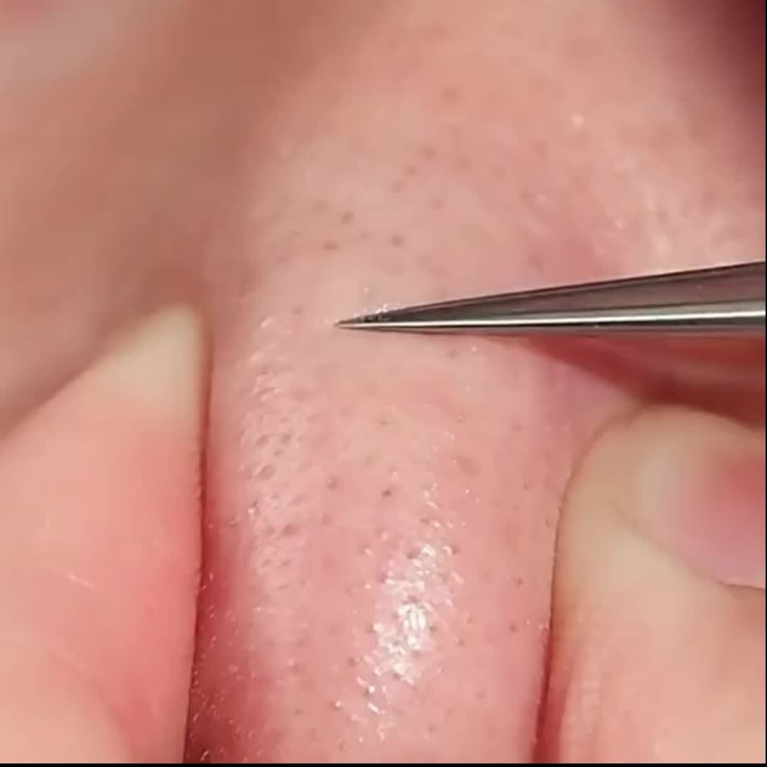 1 Pack Extra Fine No. 5 Acne Blackhead Tweezers - Facial Beauty Remove Beauty Fashion