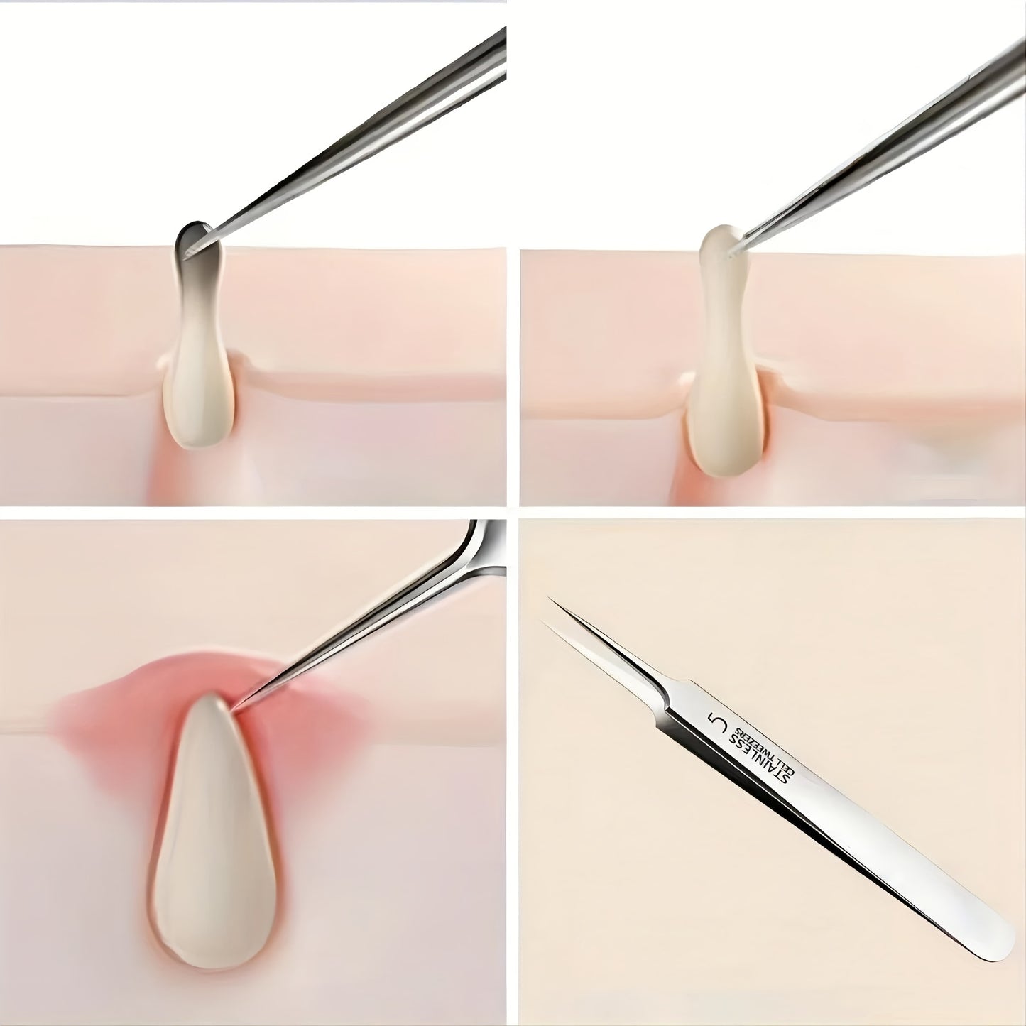 1 Pack Extra Fine No. 5 Acne Blackhead Tweezers - Facial Beauty Remove Beauty Fashion