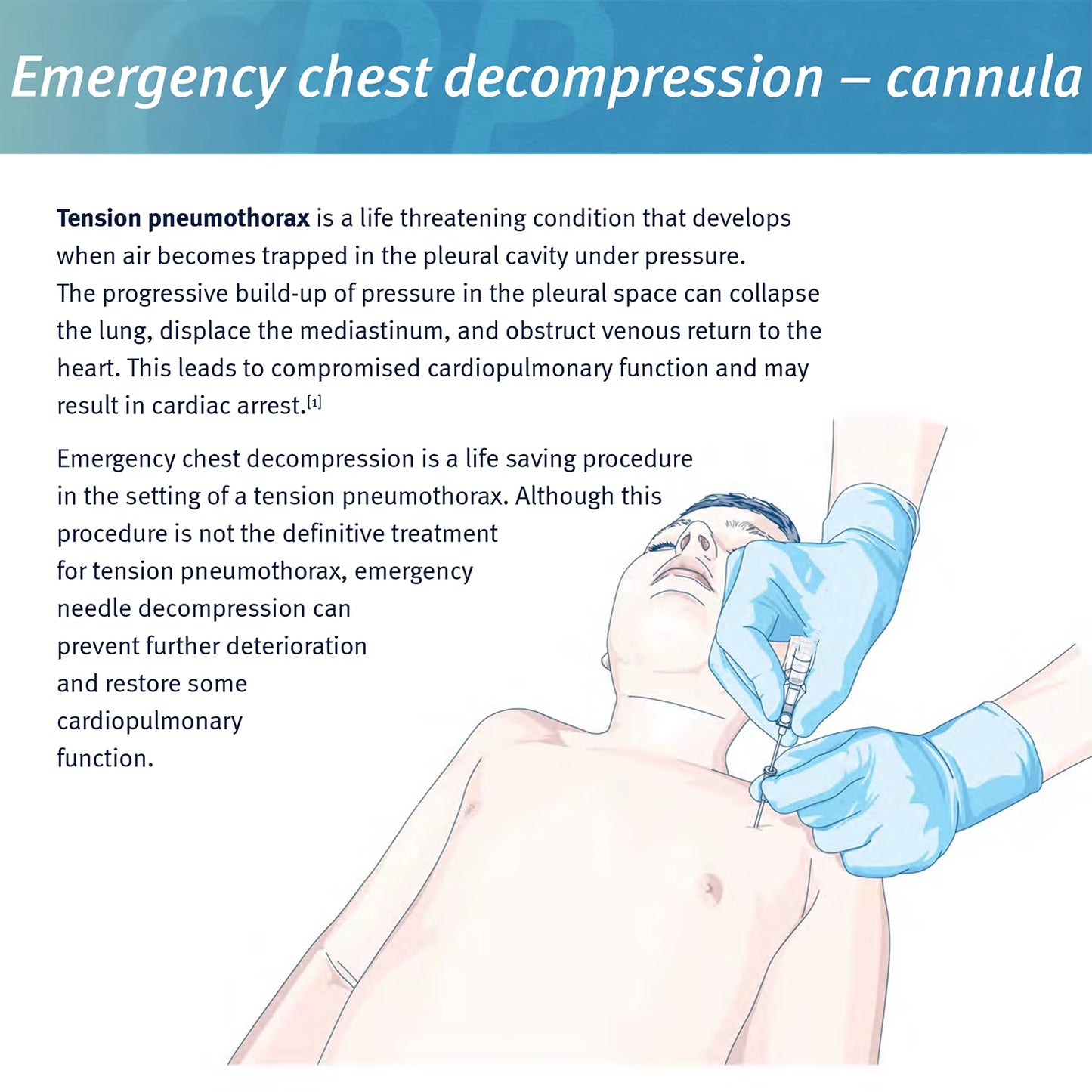 Sanke Rescue Pneumothorax Needle Trauma Medical Ifak Chest Cathether Needlecatheter 50G Needle Decompression Edc First Aid Kit