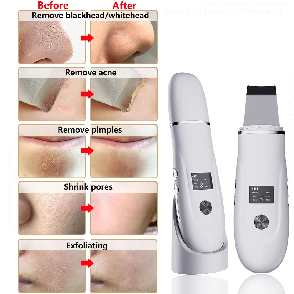 Ultrasonic Face Scrubber Facial Peeling Skin Scrubber Deep Facial Cleaning Spatula Acne Pore Ultrasonic Scrubber Facial Cleanser Beauty World Shop