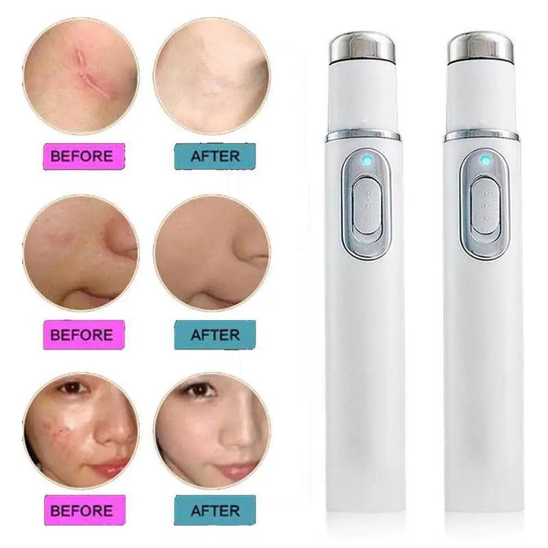 Blue Light Therapy Acne Laser Pen,LED Face Light Therapy For Scar Wrinkle Removal Treatment Device,Skin Care Beauty Appliances Beauty World Shop