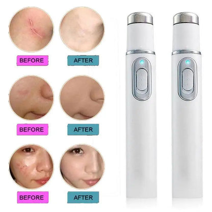 Blue Light Therapy Acne Laser Pen,LED Face Light Therapy For Scar Wrinkle Removal Treatment Device,Skin Care Beauty Appliances Beauty World Shop