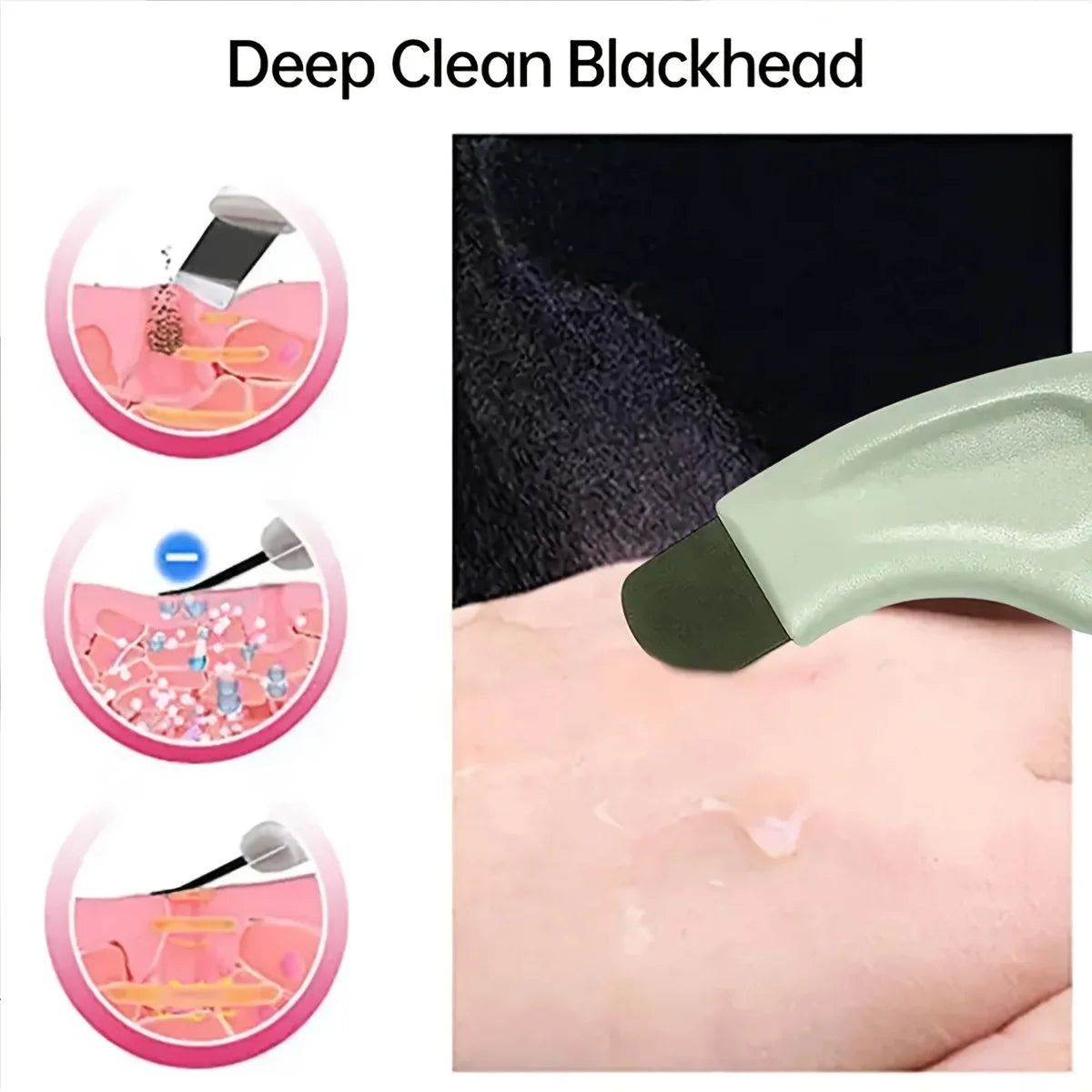 Blackhead and Whitehead Removal Tool for Nose and Face - Skin Pore Cleaner Skin Care Tools for Women Beauty World Shop