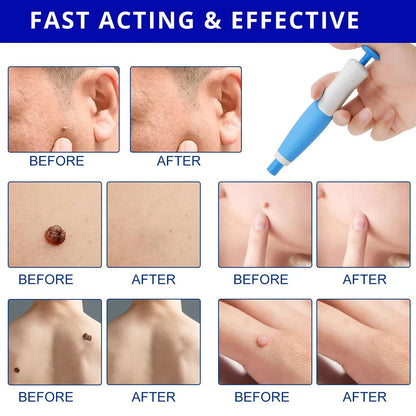 2 In 1 Face Mole Removal Tool Kits,Rubber Rings,Face Beauty Accessories Wart Tag Remover Kit  Supplies Body Wart Dot Treatments Beauty World Shop