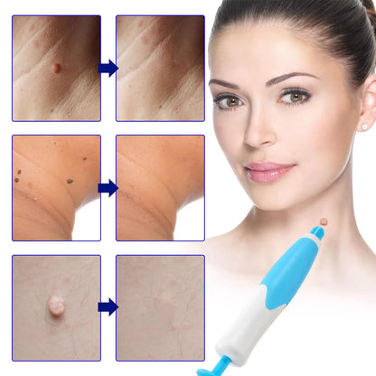 2 In 1 Face Mole Removal Tool Kits,Rubber Rings,Face Beauty Accessories Wart Tag Remover Kit  Supplies Body Wart Dot Treatments Beauty World Shop
