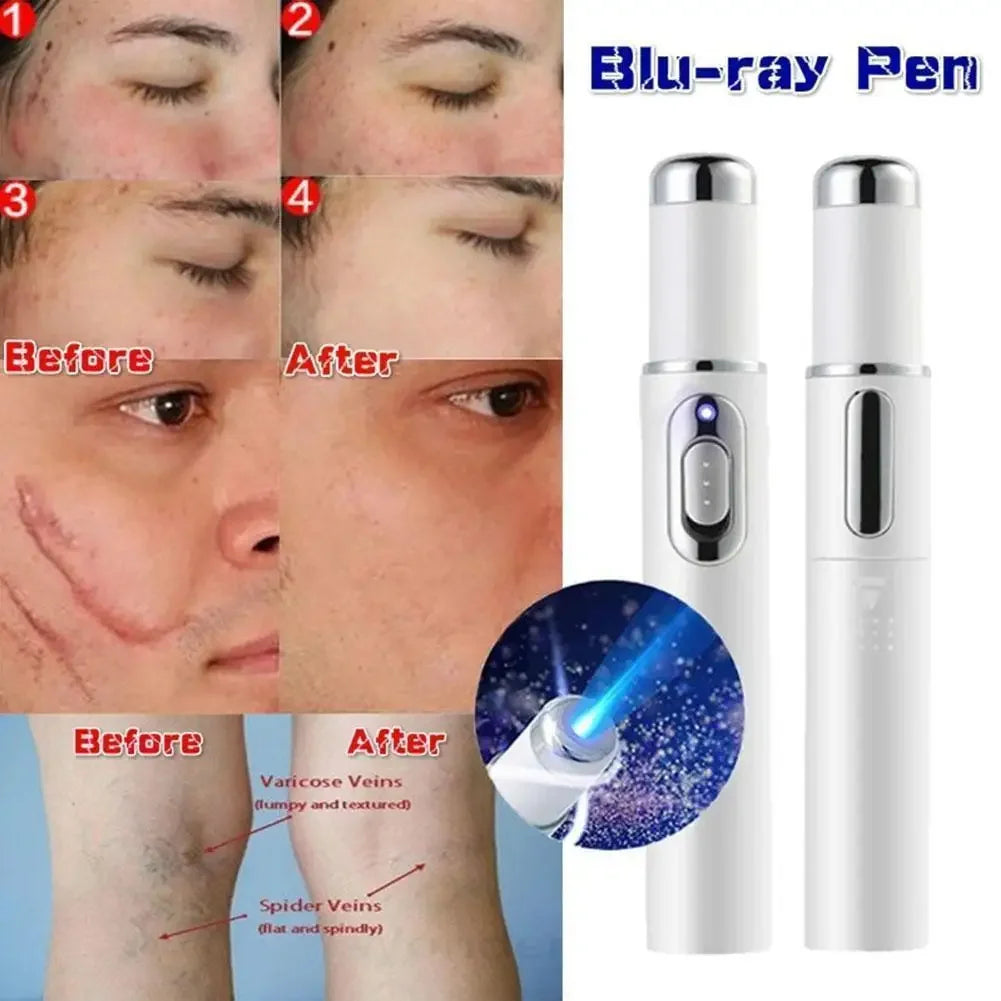 Blue Light Therapy Acne Laser Pen,LED Face Light Therapy For Scar Wrinkle Removal Treatment Device,Skin Care Beauty Appliances Beauty World Shop