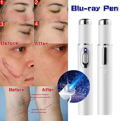 Blue Light Therapy Acne Laser Pen,LED Face Light Therapy For Scar Wrinkle Removal Treatment Device,Skin Care Beauty Appliances Beauty World Shop
