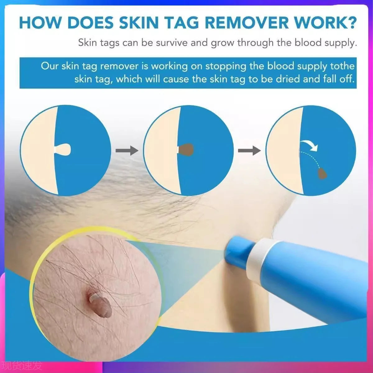 2 In 1 Face Mole Removal Tool Kits,Rubber Rings,Face Beauty Accessories Wart Tag Remover Kit  Supplies Body Wart Dot Treatments Beauty World Shop