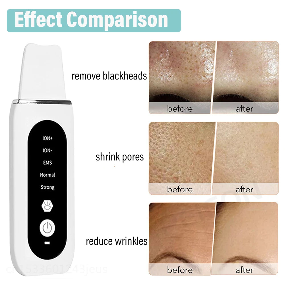 Ultrasonic Skin Scrubber Facial Peeling Face Scrubber Blackhead Remover Ance Pore Deep Facial Cleaning Spatula Facial Cleanser Beauty World Shop