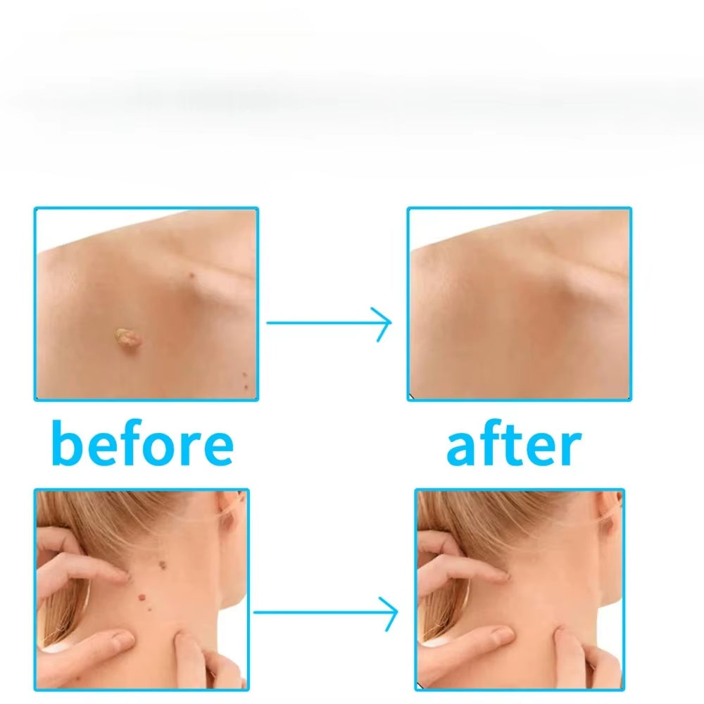 20Pcs 1-4Mm/5-8Mm Remove Skin Tag Shrink Health Beauty Skin Care Tools Rubber Ring Non Toxic Tag Removal Mole Wart Removal
