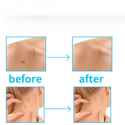 20Pcs 1-4Mm/5-8Mm Remove Skin Tag Shrink Health Beauty Skin Care Tools Rubber Ring Non Toxic Tag Removal Mole Wart Removal